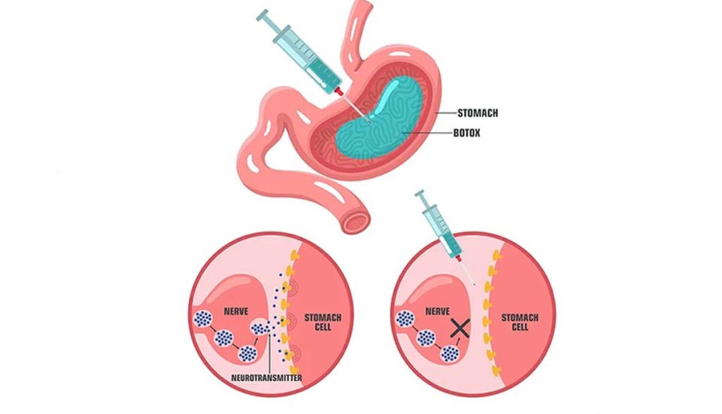 مزایای تایید شده بوتاکس معده