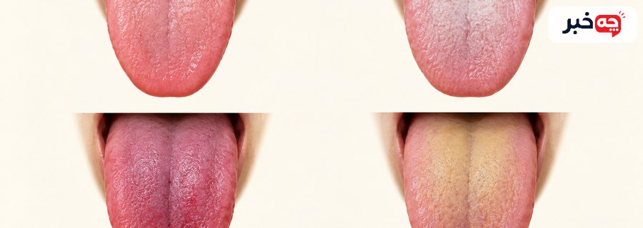 نمای آموزشی رنگ‌های مختلف زبان بدون تعیین تشخیص قطعی
